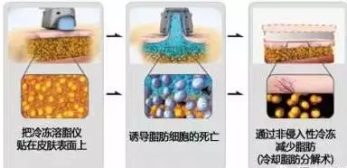 冷凍減肥儀溶脂靠譜嗎 冷凍減肥儀溶脂靠譜嗎