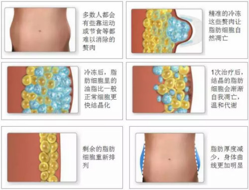 冷凍減肥儀溶脂靠譜嗎 冷凍減肥儀溶脂靠譜嗎